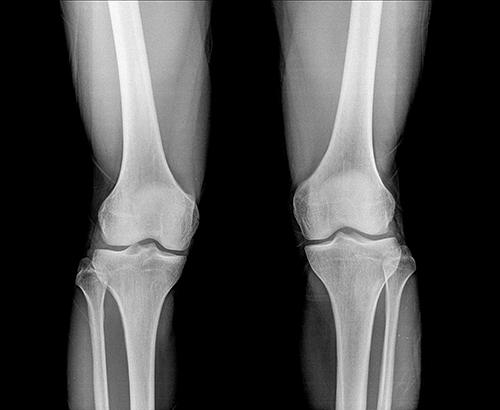 knees-xray